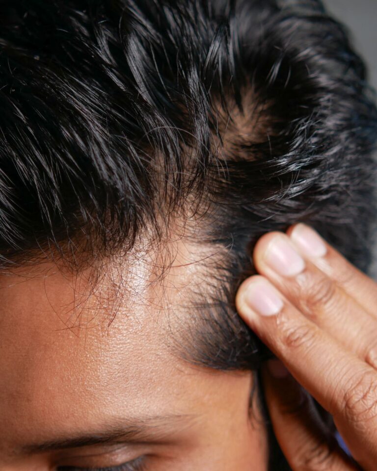 Guy needing hair restoration with PRF